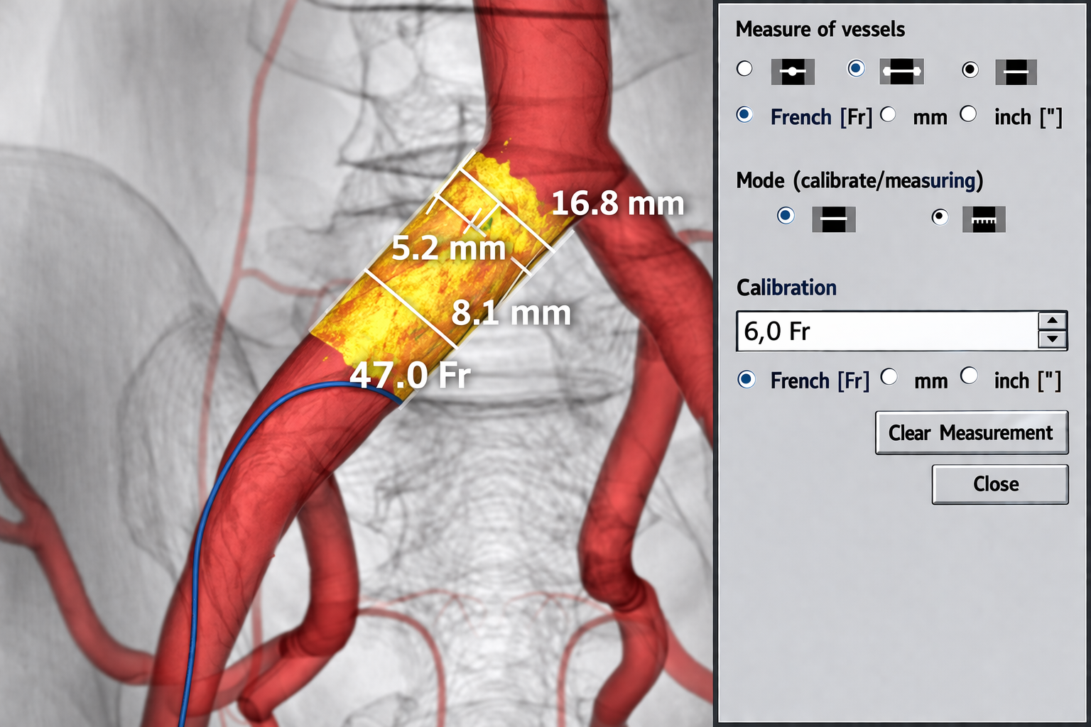 Vessel Measurement Analysis