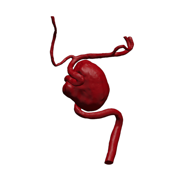 Aortic Aneurysm Model