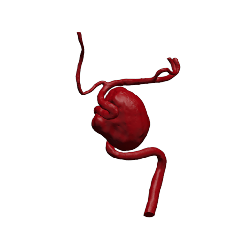 Aortic Aneurysm Model