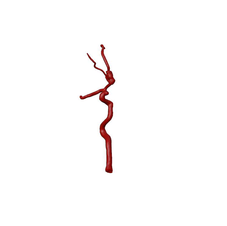 Aneurysm Model