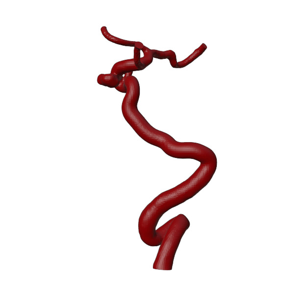 Aneurysm Model