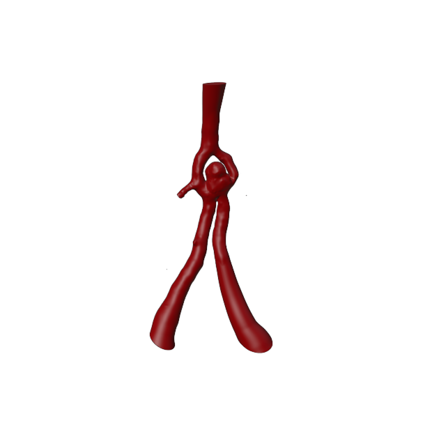 Aneurysm Model