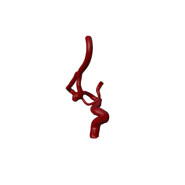 Aneurysm Model