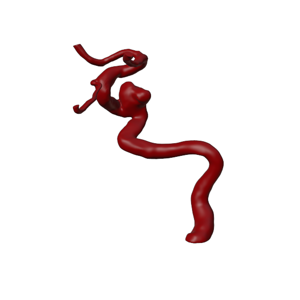 Aneurysm Model
