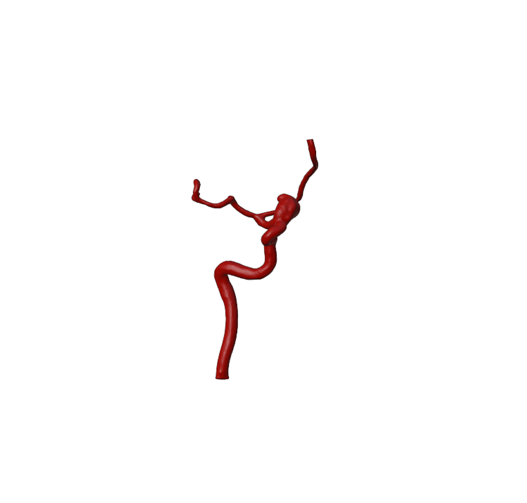 Aneurysm Model