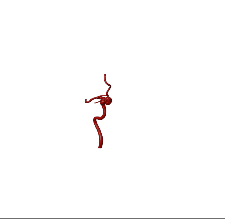 Aneurysm Model