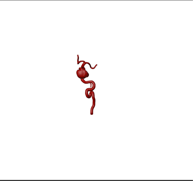 Aneurysm Model