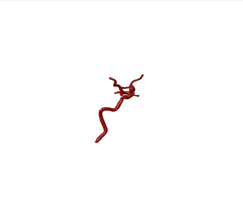 Aneurysm Model