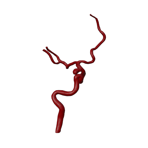 Aneurysm Model