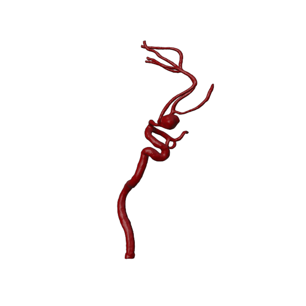 Aneurysm Model