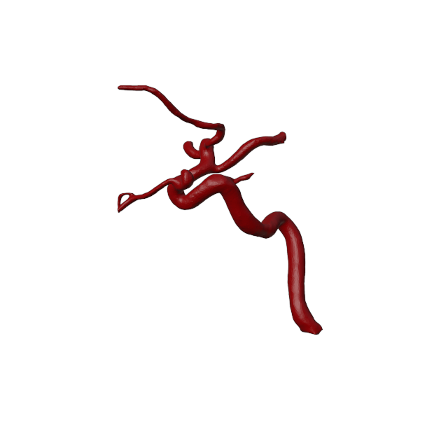 Aneurysm Model