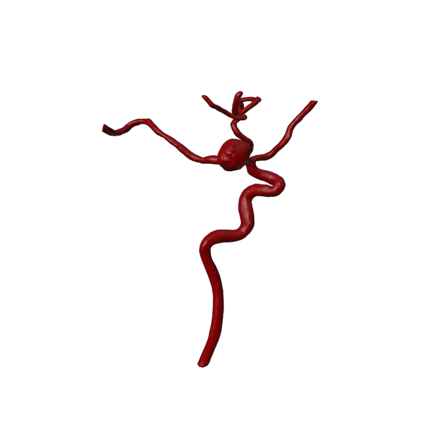 Aneurysm Model