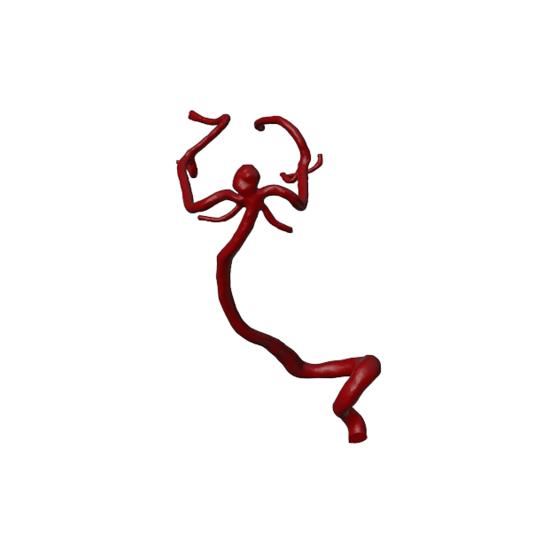 Aneurysm Model