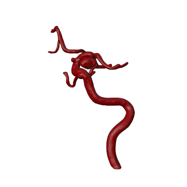 Aneurysm Model