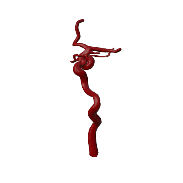 Aneurysm Model