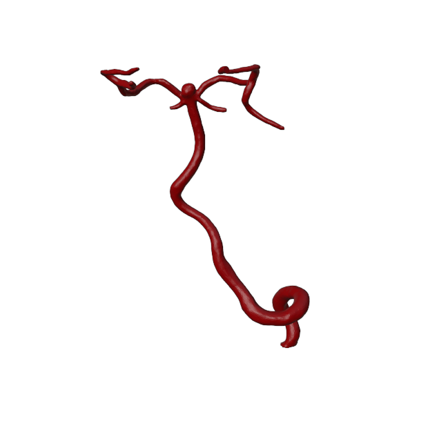 Aneurysm Model