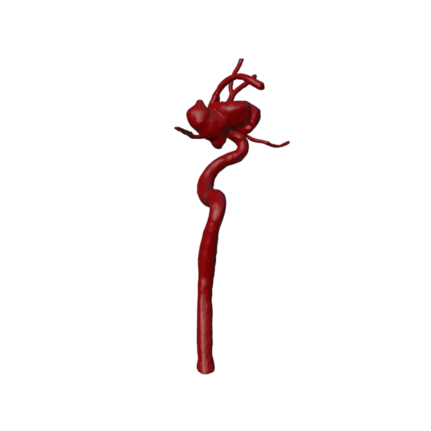 Aneurysm Model