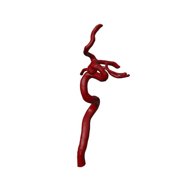 Aneurysm Model