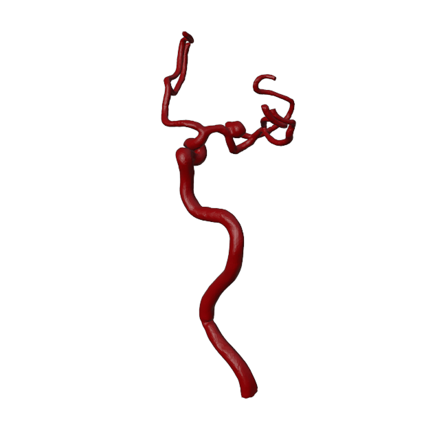 Aneurysm Model
