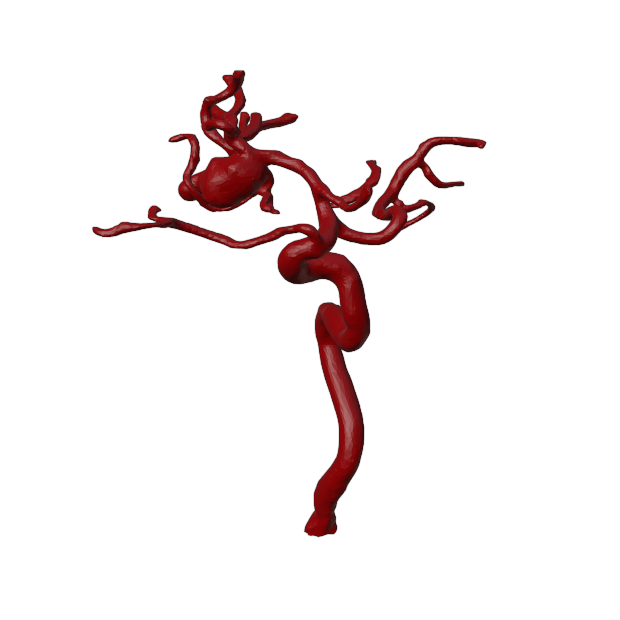 Aneurysm Model